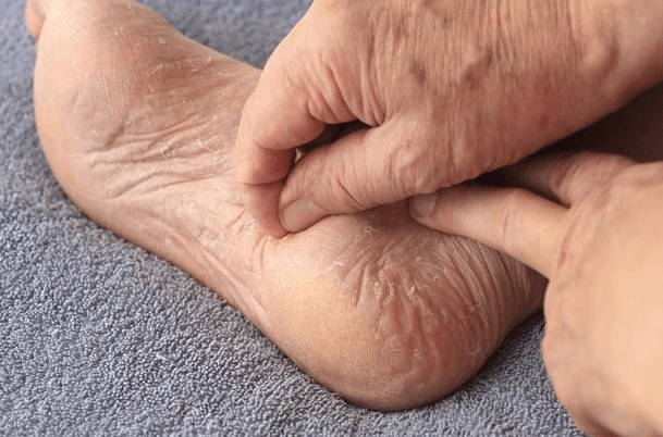 原创血糖高"脚先知"!提醒:脚部出现3种"异常",说明血糖过高了