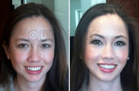 后很救命~自体脂肪填充后很后悔，脂肪填充失败修复怎么做？解决方法！