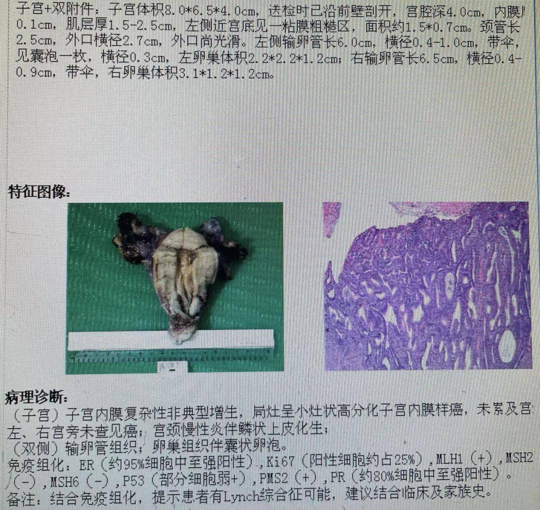 子宮內膜息肉發展成癌她原本有機會避免這個結果