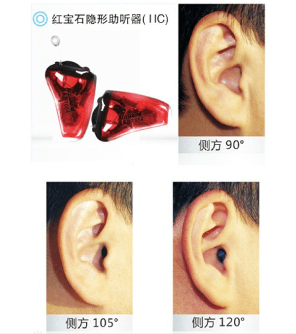 隱形助聽器佩戴效果圖隱形助聽器又稱超深耳道式助聽器(iic),是近幾年