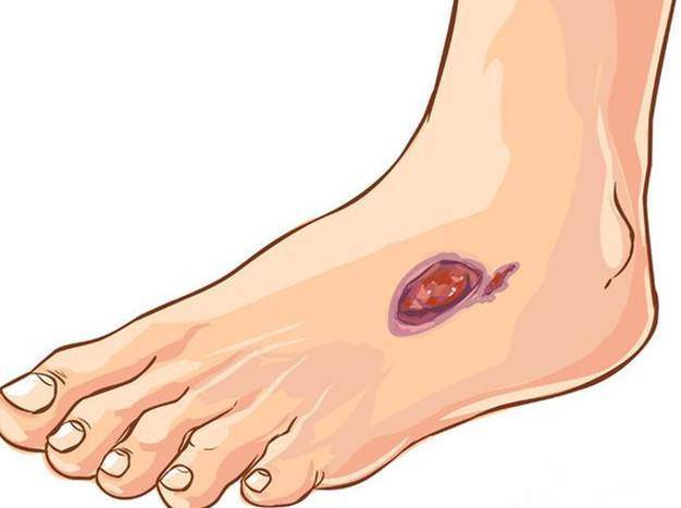 并发症|得了糖尿病烂脚该怎么去治疗才能治的好？