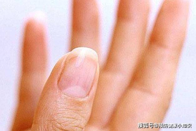 肾脏|肝好的人，手上可能有3个“记号”，若全中，恭喜，肝保养得不错