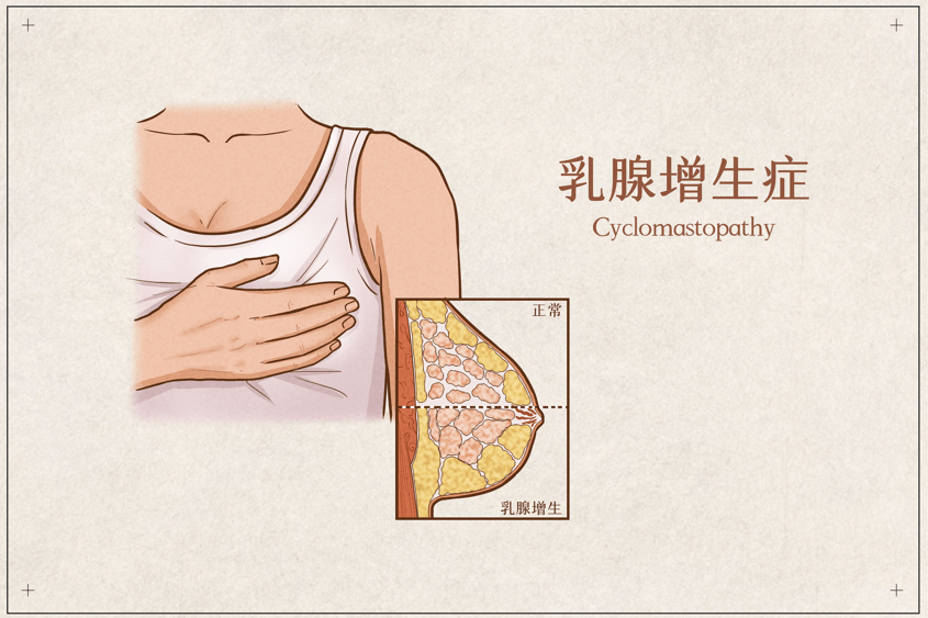 肿块|乳腺增生会变成乳腺癌吗？