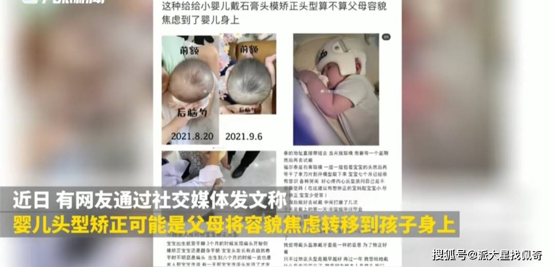 婴儿|父母给婴儿戴一套17500元“头盔”矫正头型 每天带23小时 宝宝为父母愚蠢买单