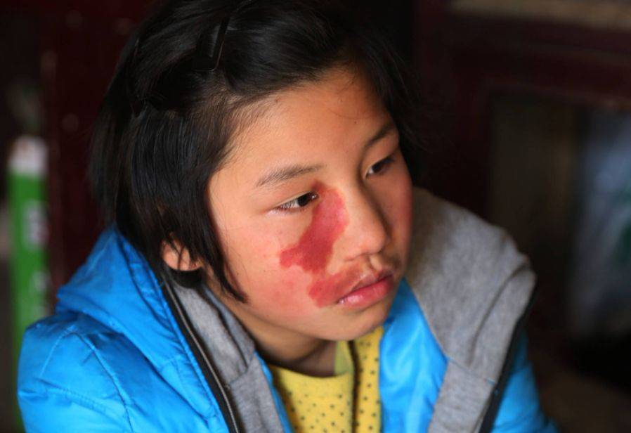 原创宝宝的胎记到底是哪来的避免宝宝长胎记孕期这些行为要避开