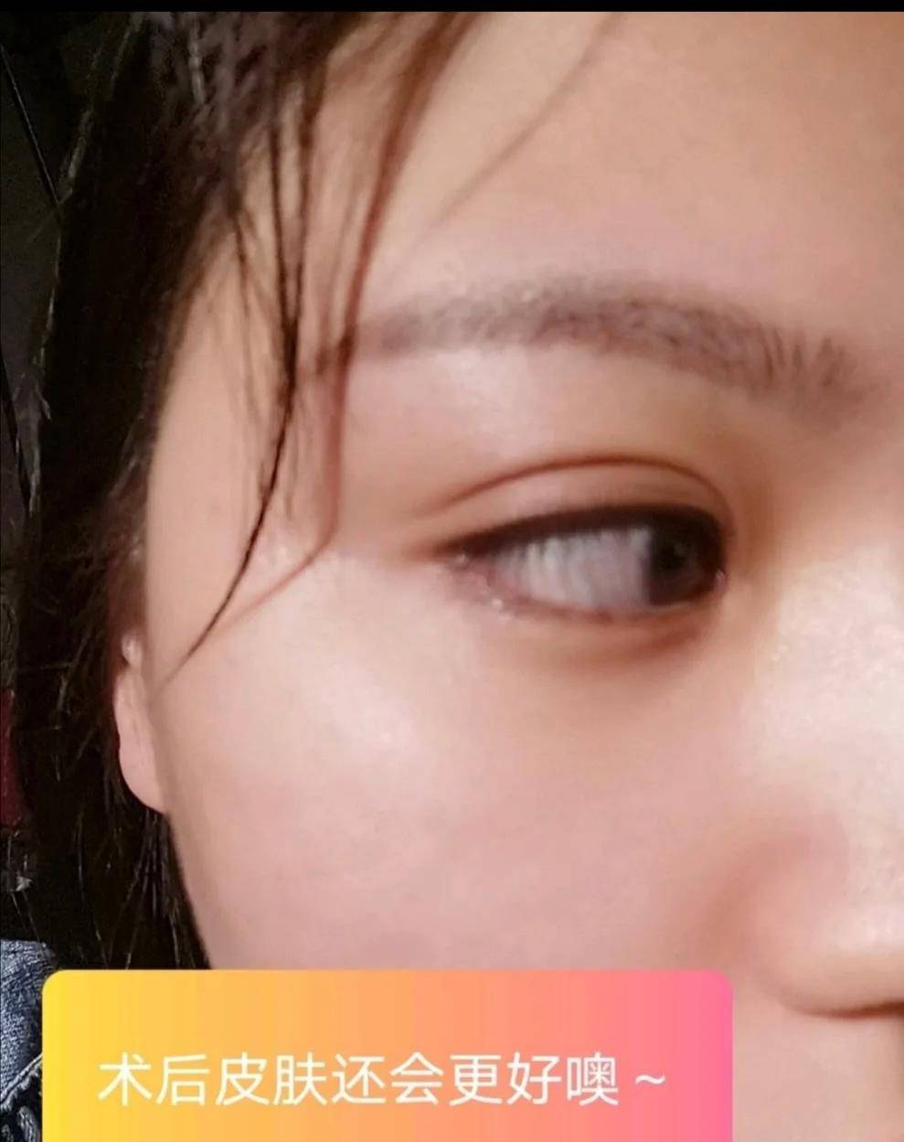 笔记水光针之后一定要用修护面膜哦！