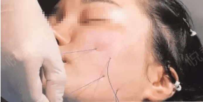 分析专业分析:蛋白线埋线一根多少钱?胶原蛋白线这个价格贵不!靠谱吗