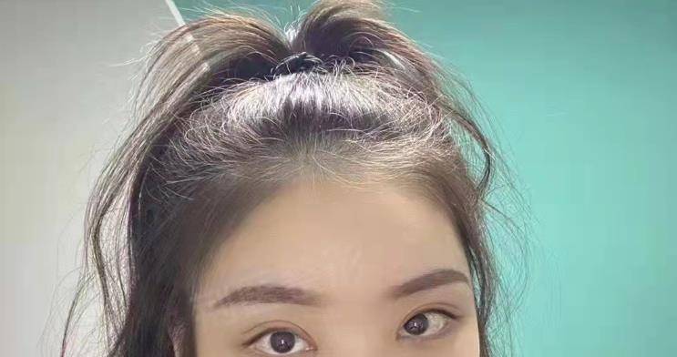 眼睛双眼皮手术后，我经历了半个月的焦虑……有没有同样感受的？