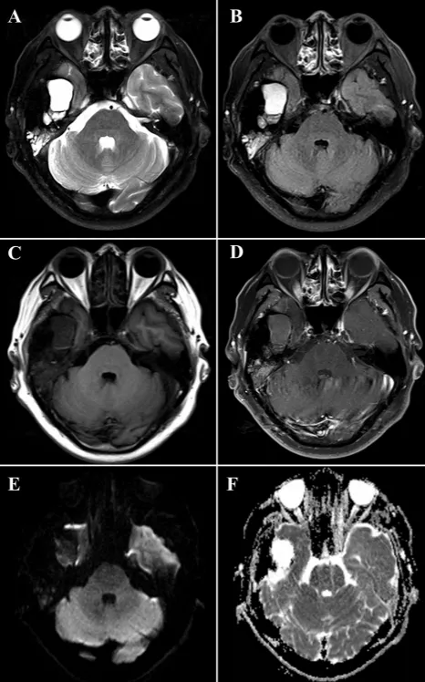 48 歲,男,右顳下頜關節瀰漫性 tgct,ct 平掃示右側顳下頜關節區高密度