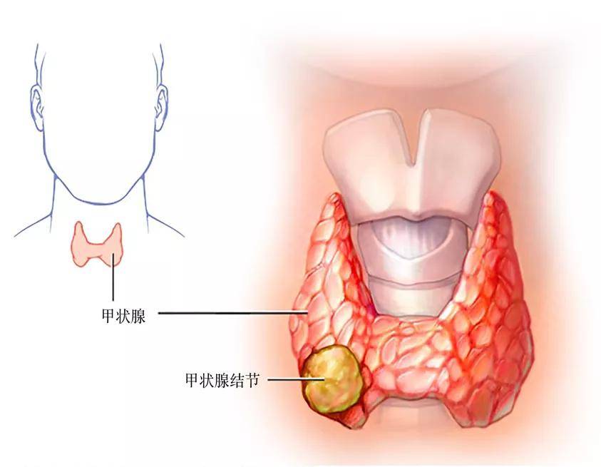 以前甲狀腺結節的診斷依賴外科醫生觸診,一般只能發現1cm以上的結 ..