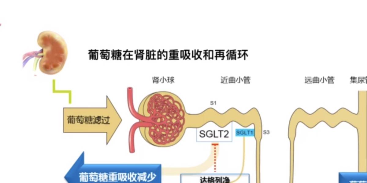达格列|作用独特，达格列净把吃进的糖分尿出去！心梗病人用降糖效果不错