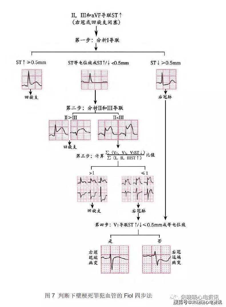 回旋支闭塞心电图表现图片