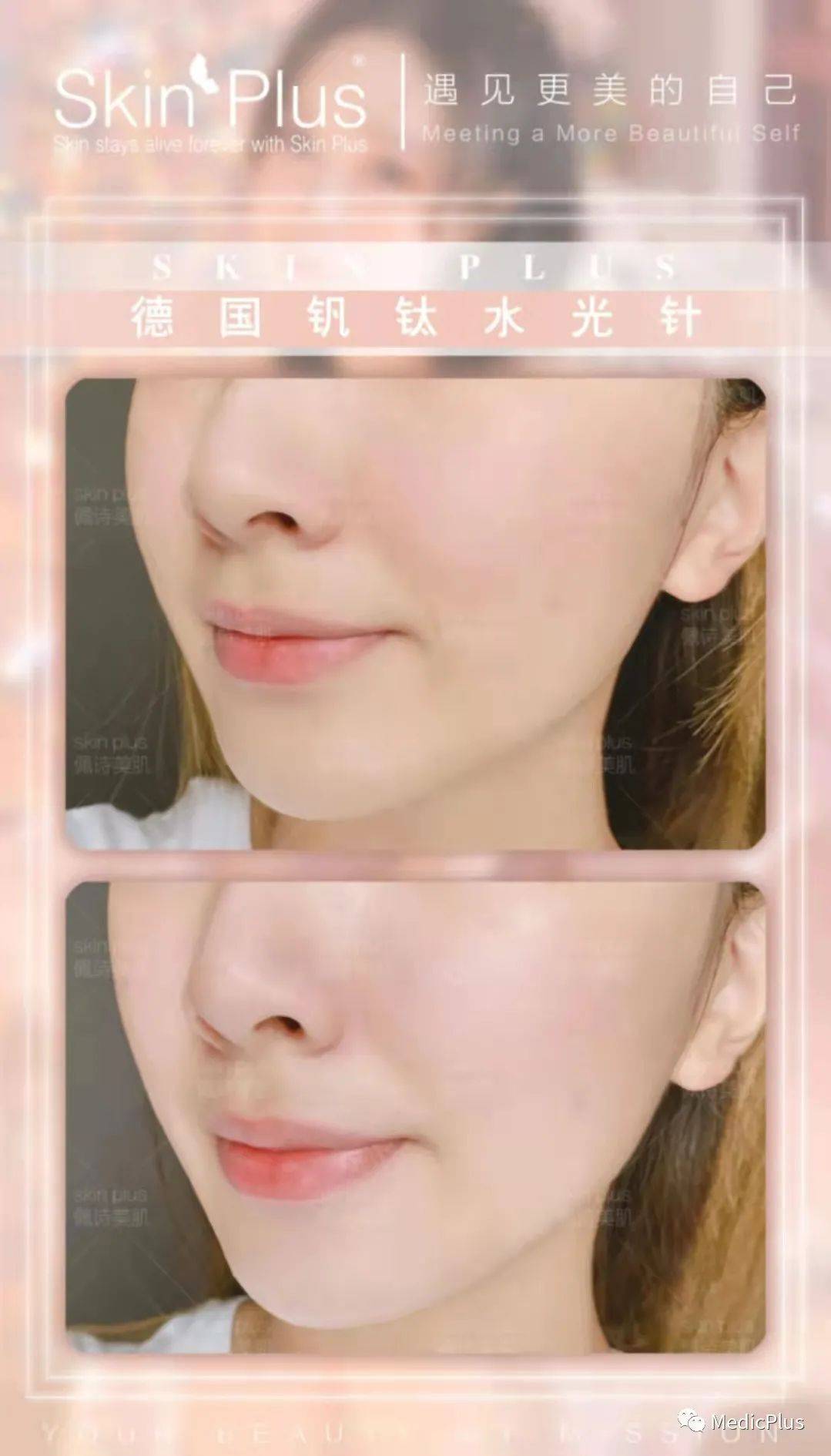 讲真水光针这样搭配打绝了