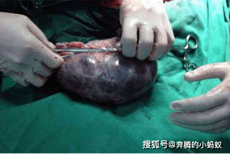 治疗|得了囊肿不管它，对身体会有影响吗？