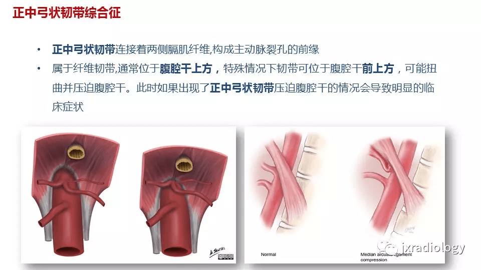 影像科必會的6種腹部血管壓迫中英高清