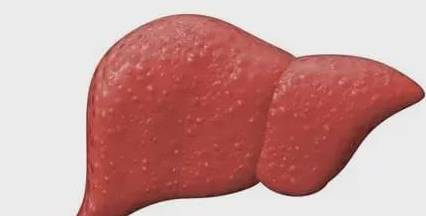 肝脏|从肝病的角度看，右上腹疼痛一般是什么原因？应该如何应对？