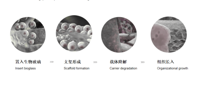 进行液态膨体 | 非术俏鼻精雕专属可降解骨性填充塑形材料