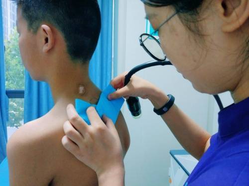 李娜|合肥华夏白癜风医院李娜主任：美国308激光祛白效果好