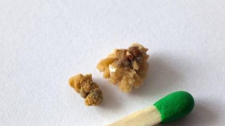 肾脏|重视治疗是将结石疾病危害降到最低的最有效方式