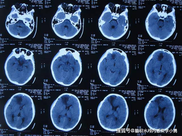 大池|7岁儿童脑出血后脑积水，腰大池引流术后加重感染，顽固性持续发热30余天