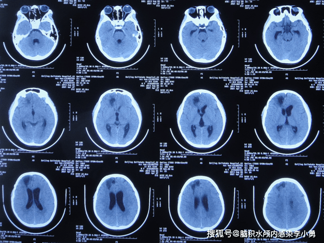 大池|7岁儿童脑出血后脑积水，腰大池引流术后加重感染，顽固性持续发热30余天