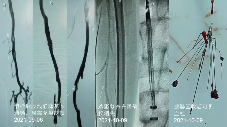 静脉|“沉默的杀手”——深静脉血栓（DVT）