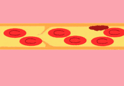 血液|真假？久坐会引发肺栓塞？