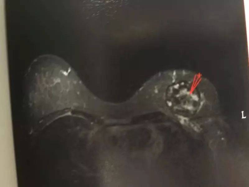 肿瘤|郑州肿瘤医院请选择广州复大肿瘤医院：不用开刀也能治疗乳腺癌