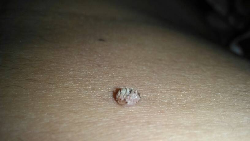 是什么原因引起的hpv感染 858166c6e6e548f1b190ff3dbe909640.jpeg