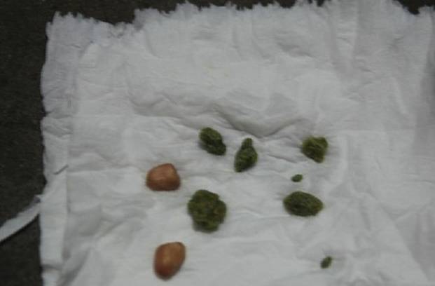 肾脏|肾结石有哪些危害，如何预防？