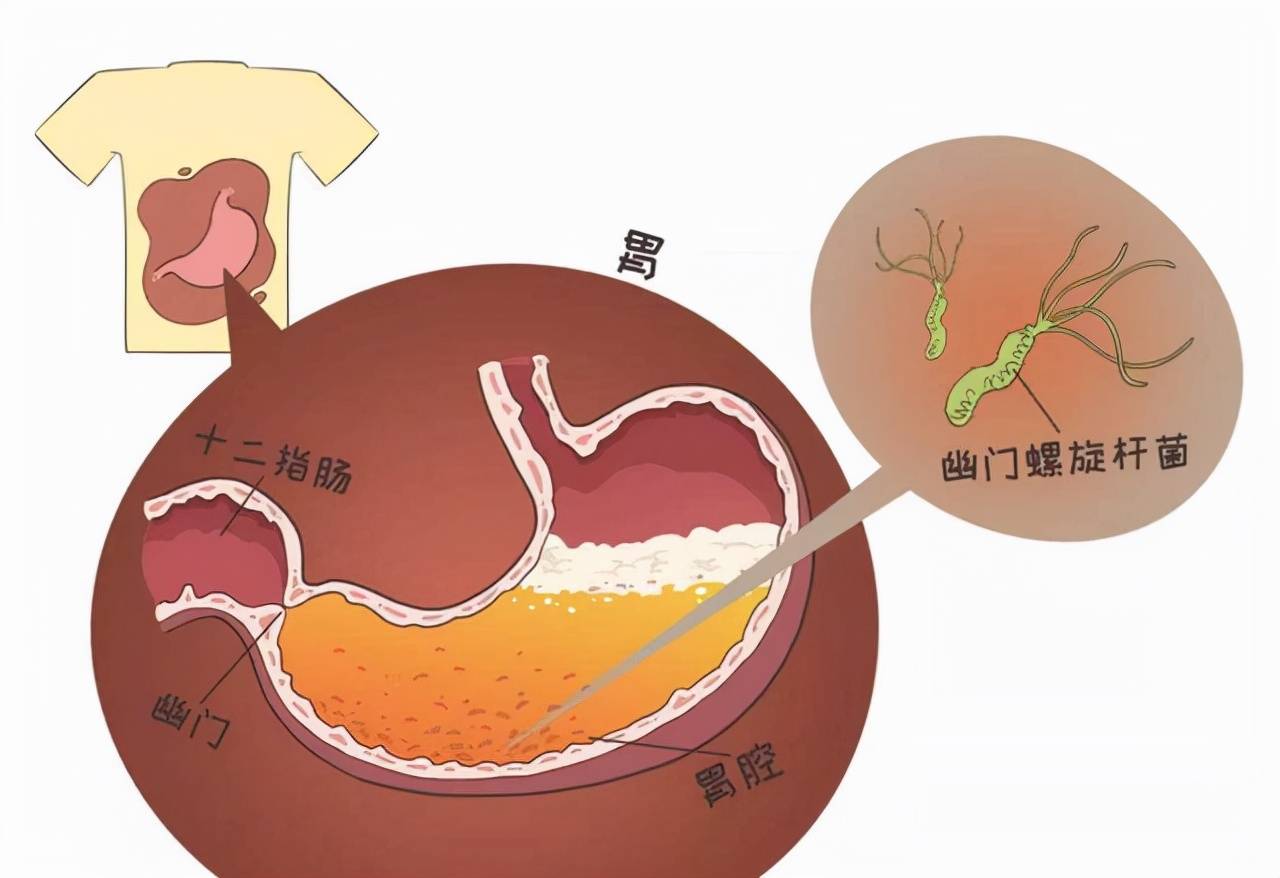 为什么会出现胃息肉?_胃镜