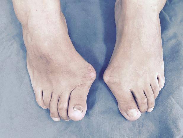 上海健桥医院拇外翻侯明主任:得了大脚骨怎么治疗比较好_关节