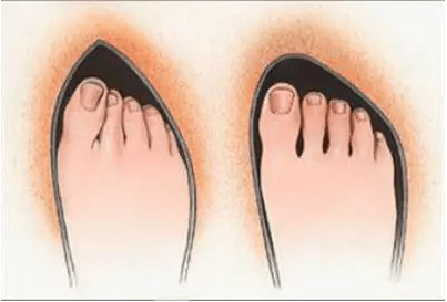 上海|上海健桥医院拇外翻侯明主任：拇外翻最佳治疗方法