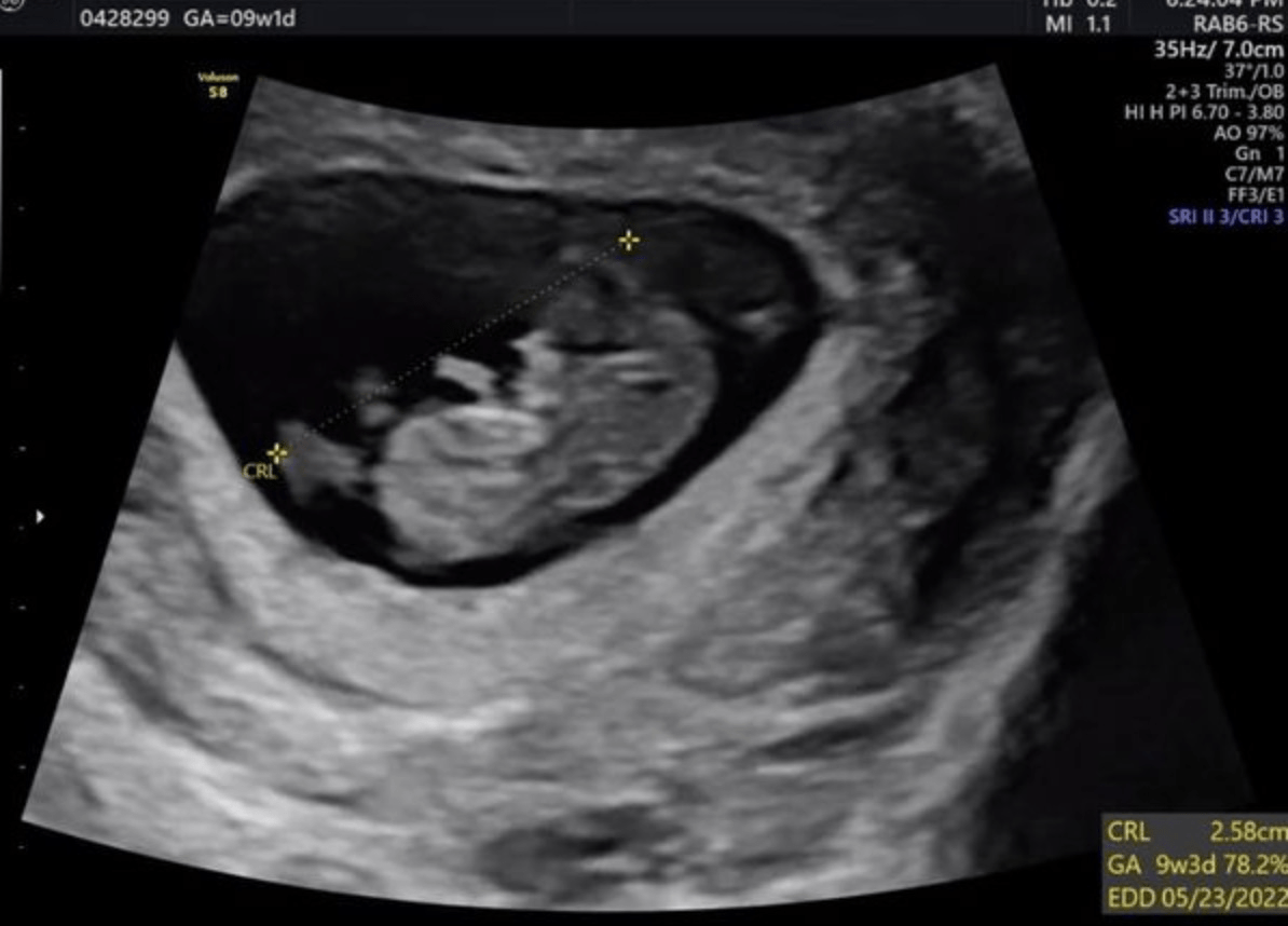 怀孕5个月女宝宝b超图图片