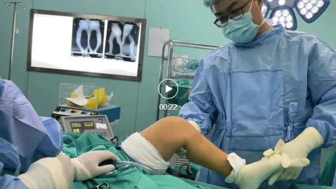 儿童骨骼先天发育不良,o型腿严重,胫骨高位截骨来拯救!