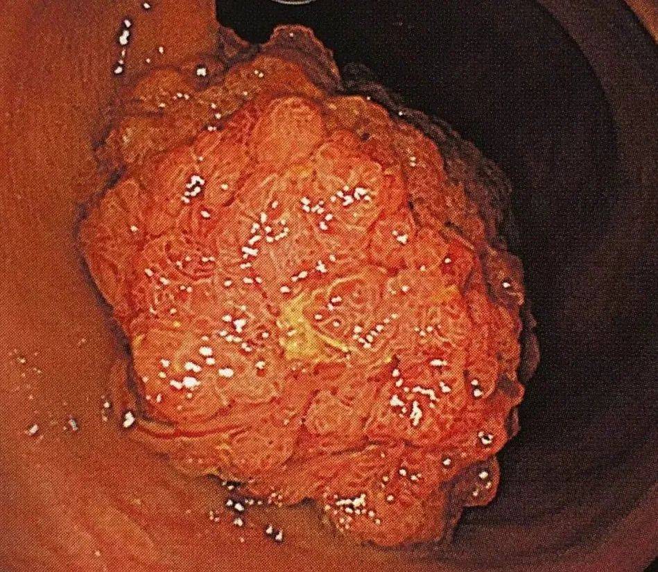 管状腺瘤性肠息肉图片图片