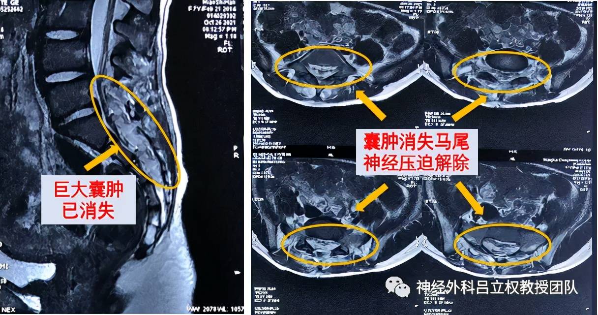 骶管巨大囊肿致小便失禁微创手术解尴尬难题