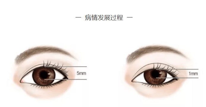 严重|卢老健康课堂:发现睁眼困难、眼睑下垂谨慎—眼肌型重症肌无力！