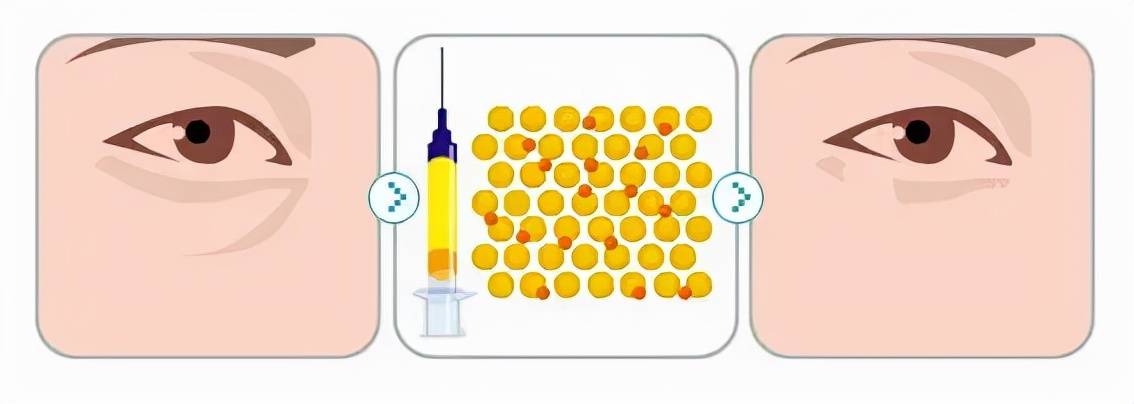 脸部理性变美：脸部脂肪填充能保持几年?泪沟脂肪填充维持多久？解答~