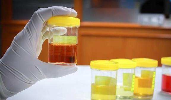 出现泡沫|血糖高，尿液也许有这3种“异常”，若你没中，祝贺血糖还算稳定