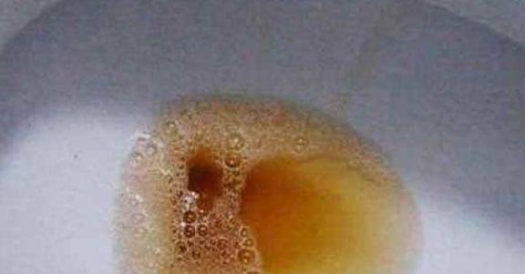 进行|肝不好时，可能有“3黄2臭”的表现，远离“4怕”，肝会一天天好