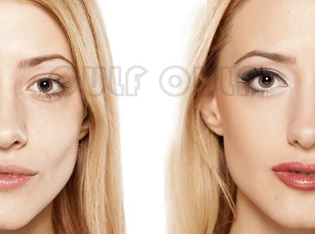 脸部全面还原:脸部脂肪填充恢复过程，全脸脂肪填充5到10天照片~