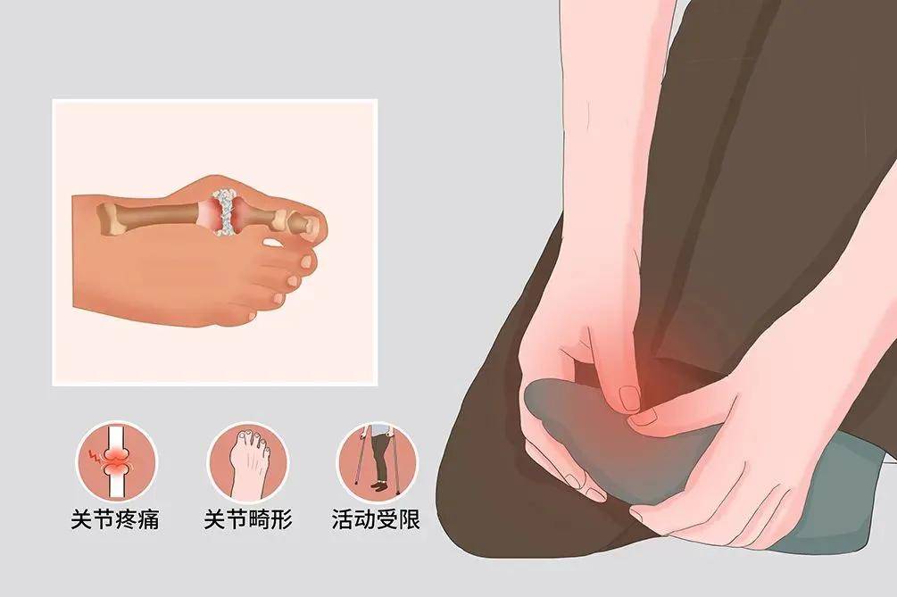 治疗|百草济世：不死的癌症——痛风，看中医如何治！