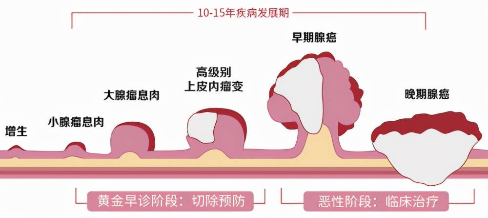 關於腸息肉,這些問題你知道嗎?