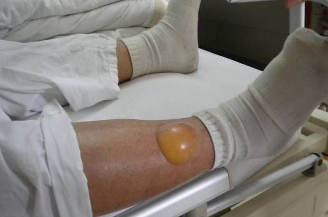 症状|糖尿病患者出现5个症状，警惕一个并发症，否则后悔也来不及！