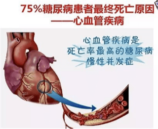 糖尿病可能发生的并发症