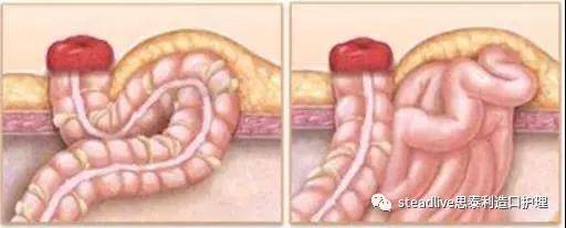 指身體的某些部分(比如腸道),通過組織間的缺損或薄弱處進入另一部位