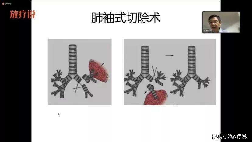 庞大志医生进行演讲现今还有:全 vats支气管袖式肺叶切除,单孔vats支