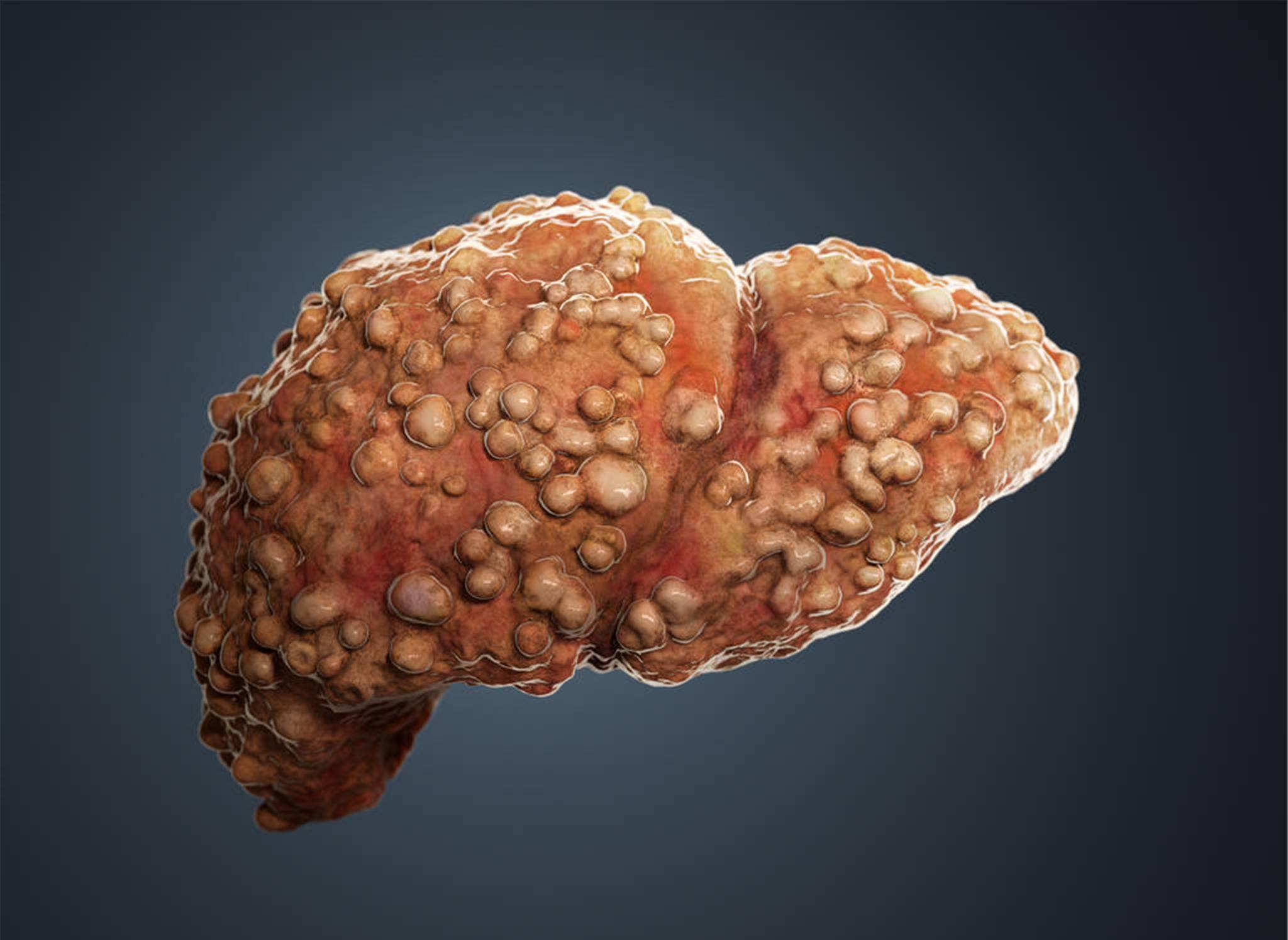 韩华东|35岁男子肝癌晚期,提醒大家:皮肤出现“蜘蛛痣”,及时检查