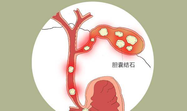 时间|16岁女孩，胆囊长满结石，医生：她的2个坏习惯，不少年轻人都有